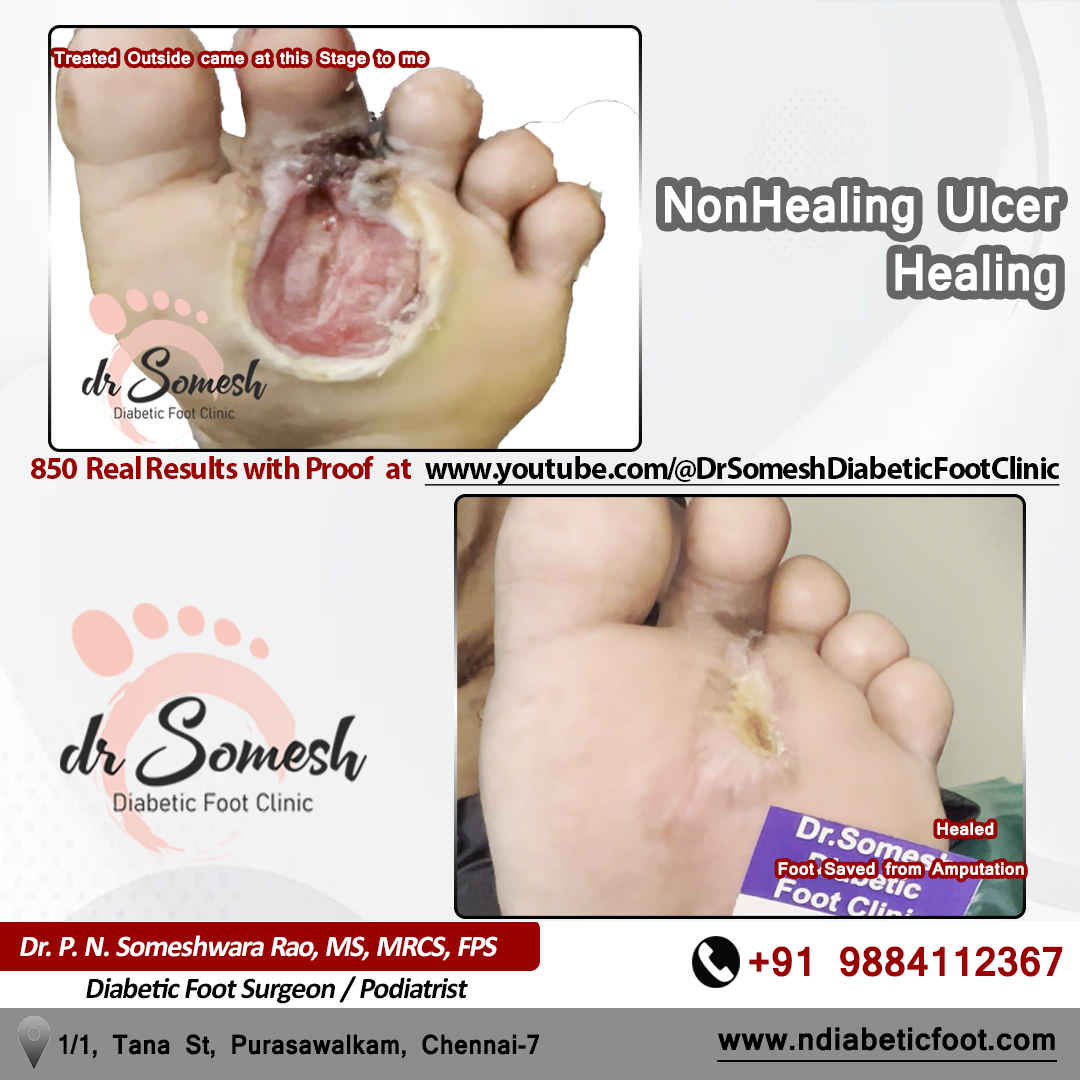 podiatrist chennai | diabetic foot clinic