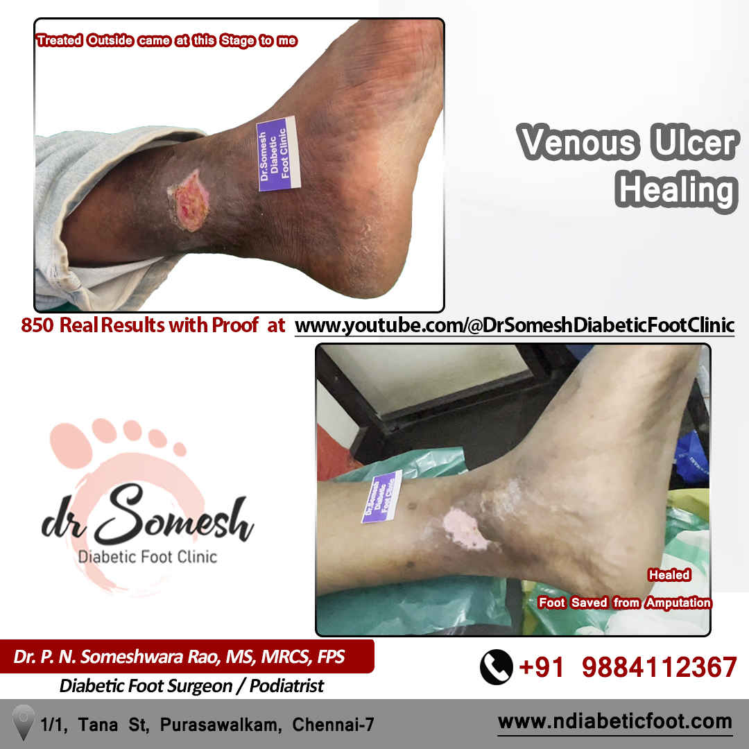 podiatrist chennai | diabetic foot clinic