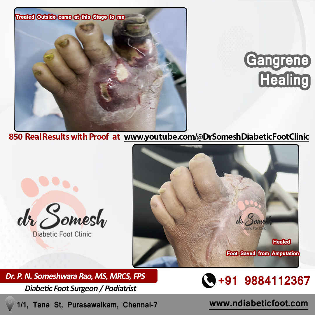 podiatrist chennai | diabetic foot clinic