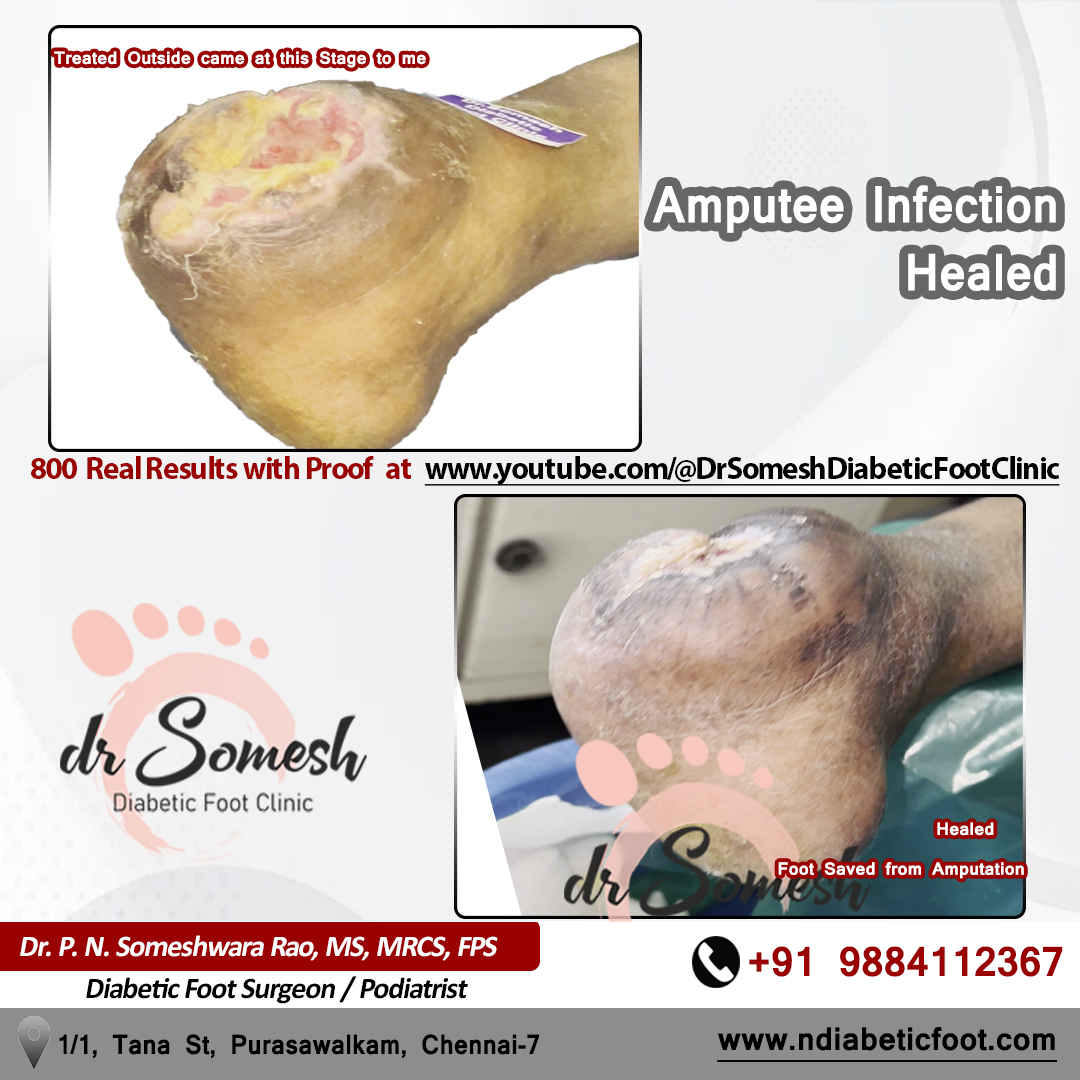 podiatrist chennai | diabetic foot clinic