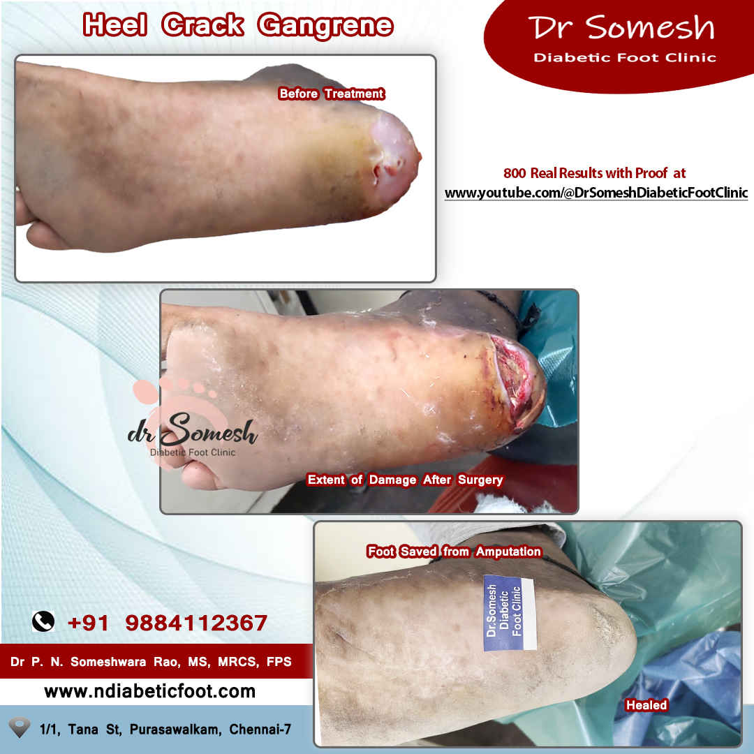 podiatrist chennai | diabetic foot clinic