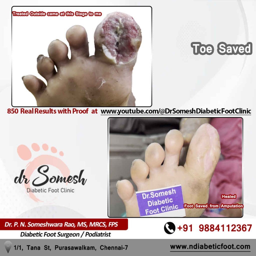 podiatrist chennai | diabetic foot clinic
