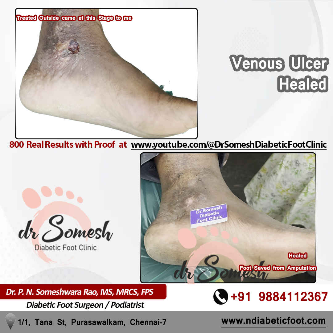 podiatrist chennai | diabetic foot clinic