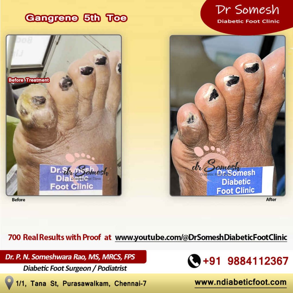 podiatrist chennai | diabetic foot clinic