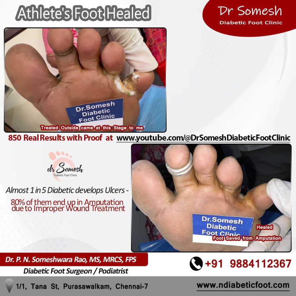 podiatrist chennai | Athlete's foot