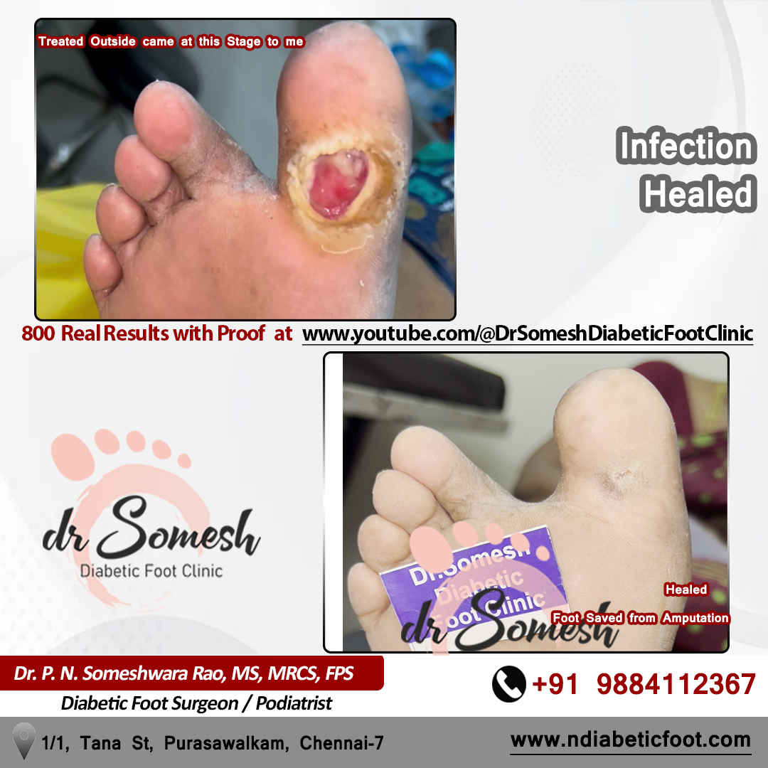 podiatrist chennai | diabetic foot clinic