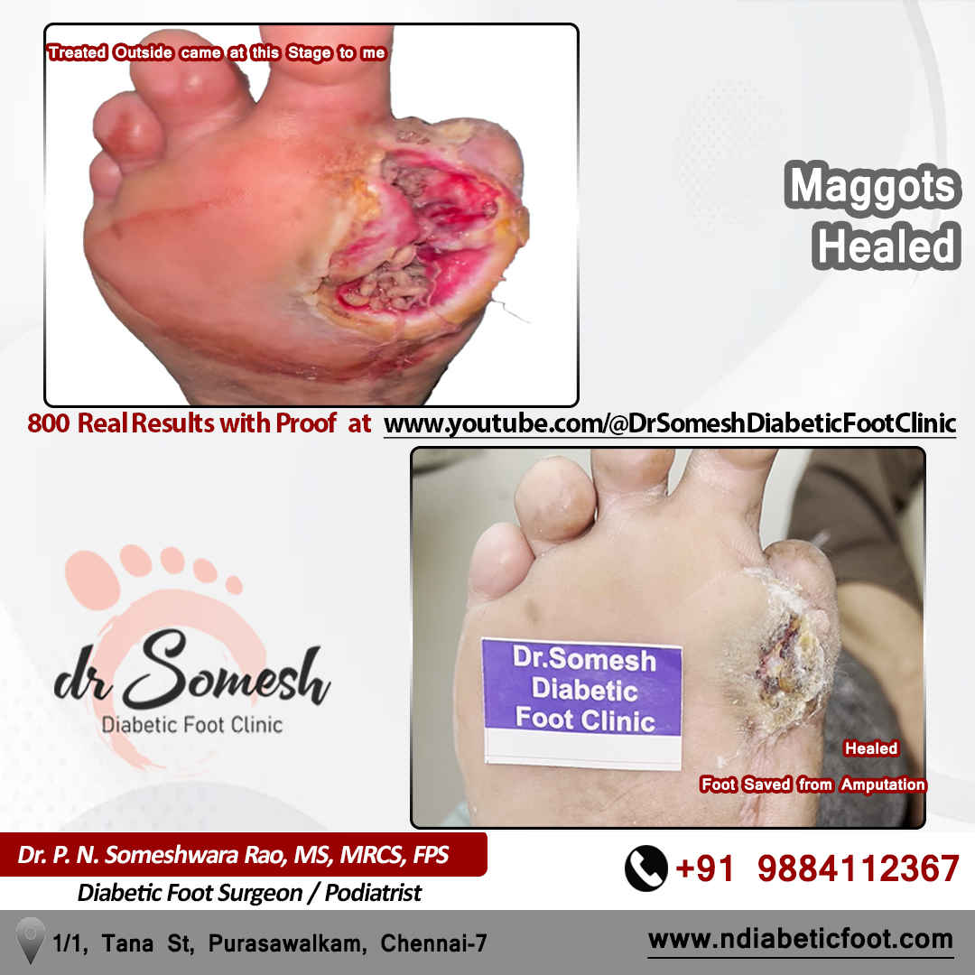 podiatrist chennai | diabetic foot clinic