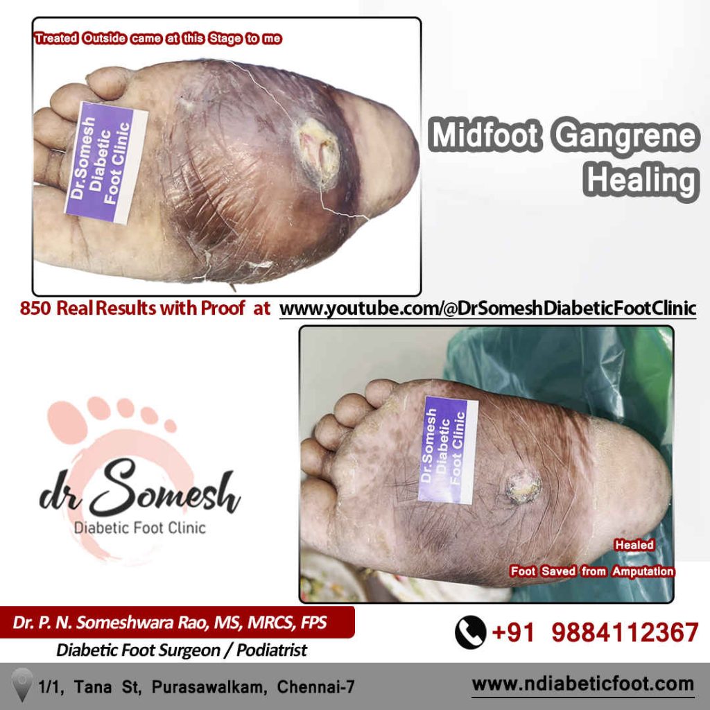 podiatrist chennai | diabetic foot clinic