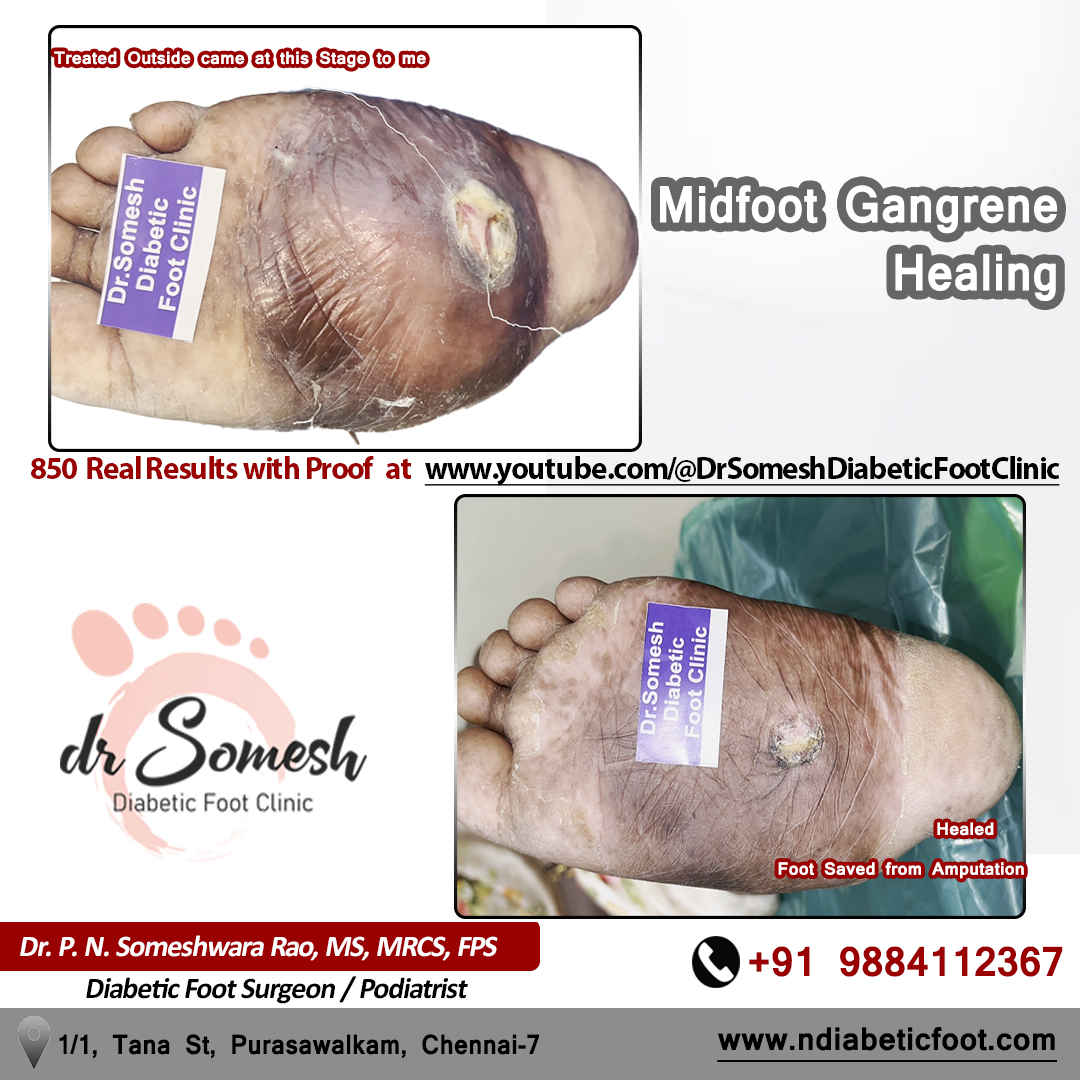 podiatrist chennai | diabetic foot clinic