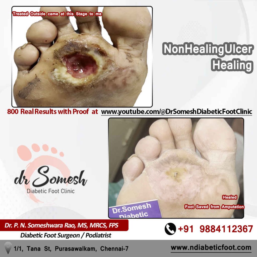 podiatrist chennai | diabetic foot clinic