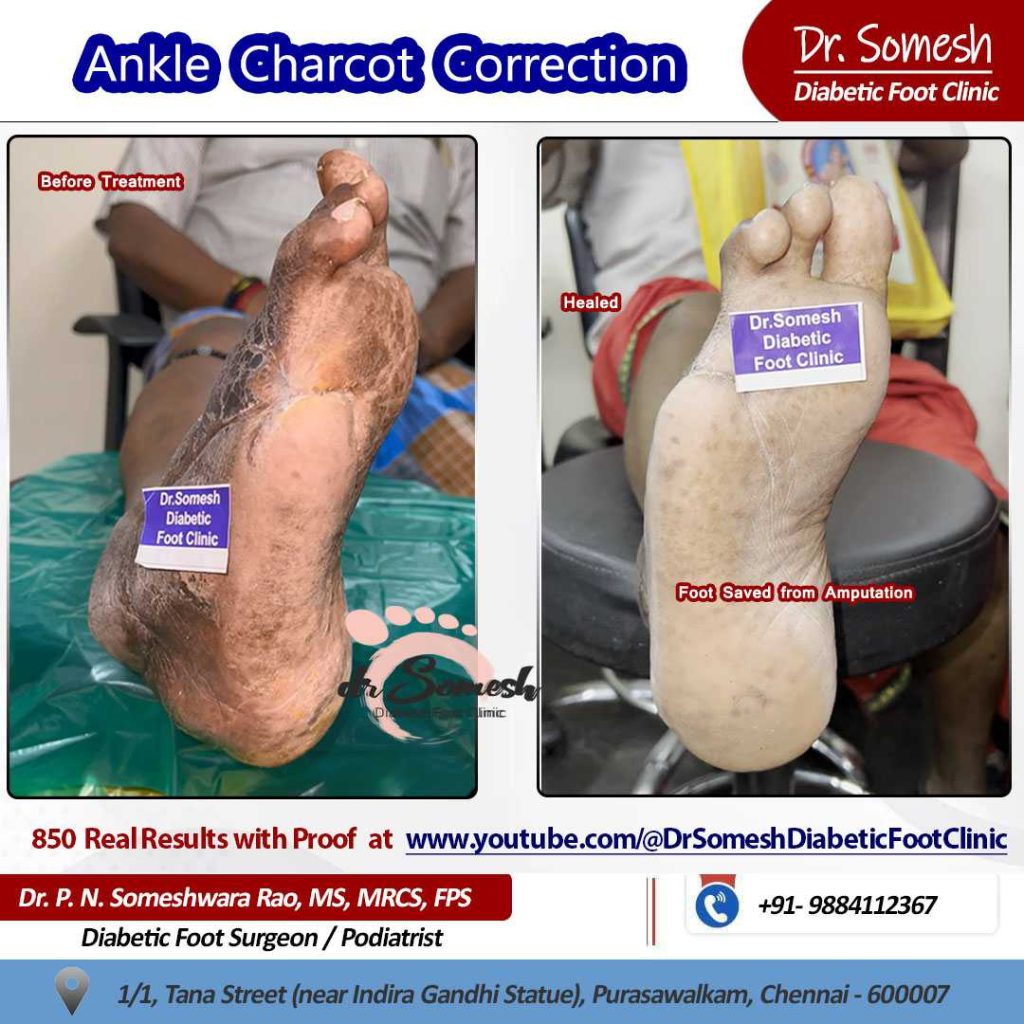 podiatrist chennai | charcot foot
