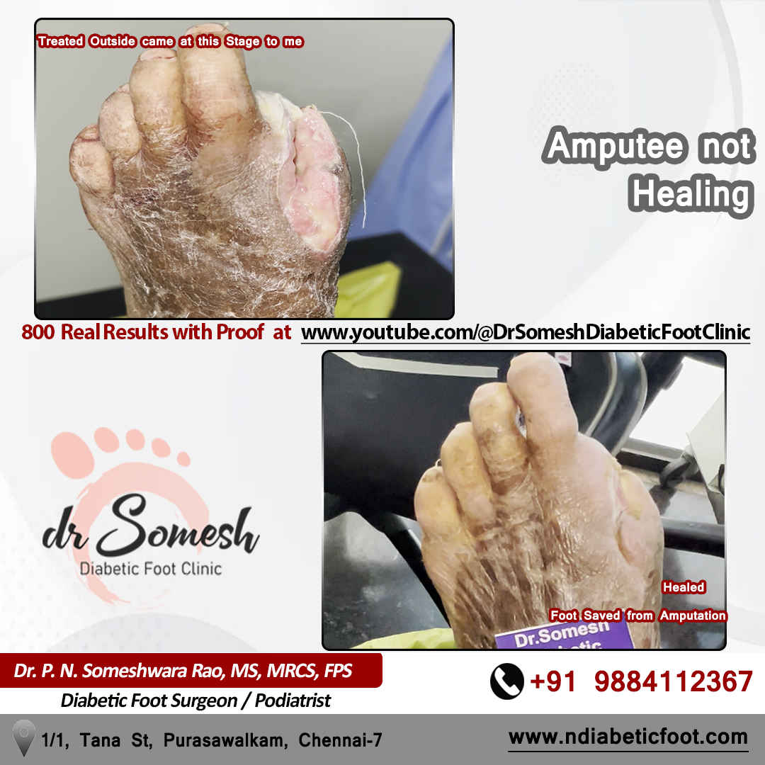 podiatrist chennai | diabetic foot clinic