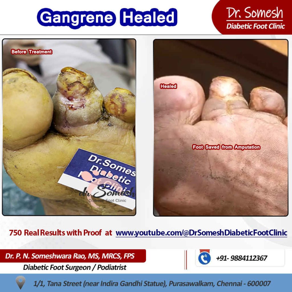 podiatrist chennai | diabetic foot clinic