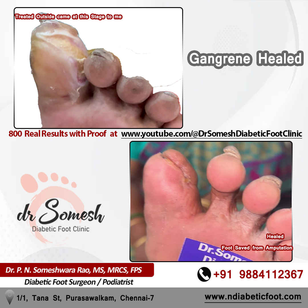 podiatrist chennai | diabetic foot clinic