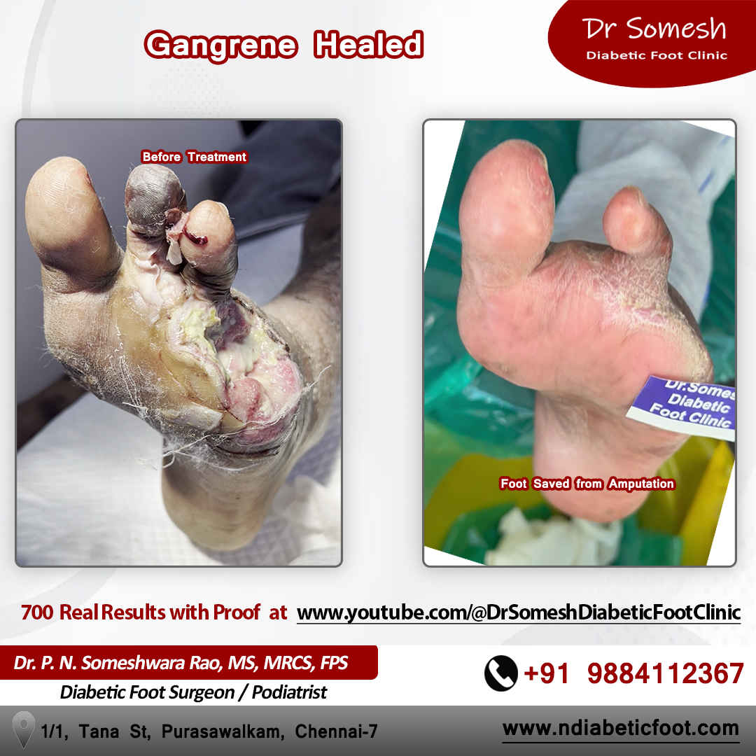 podiatrist chennai | diabetic foot clinic