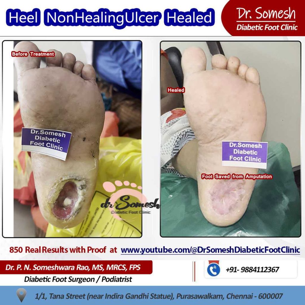 podiatrist chennai | Heel non healing ulcers