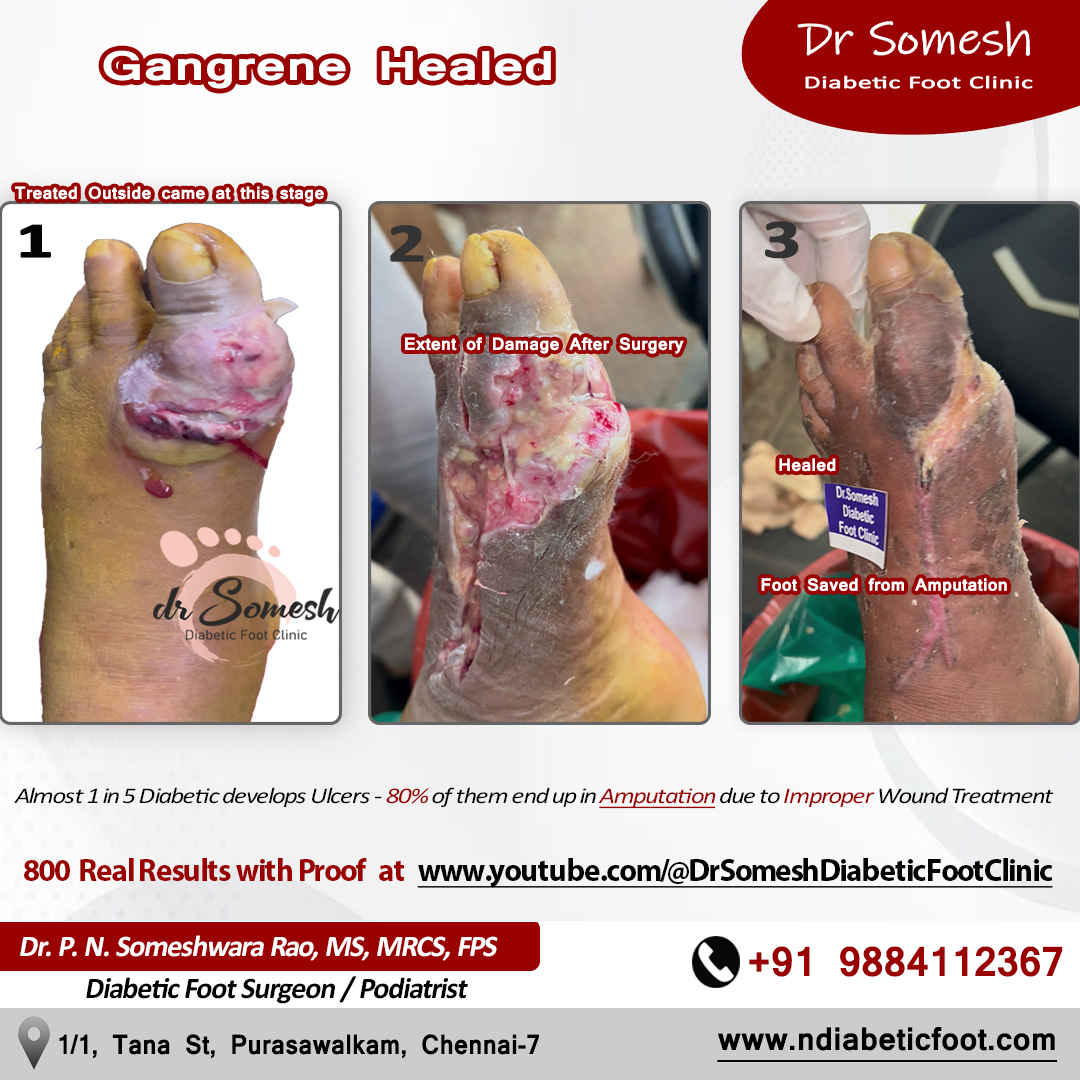 podiatrist chennai | diabetic foot clinic
