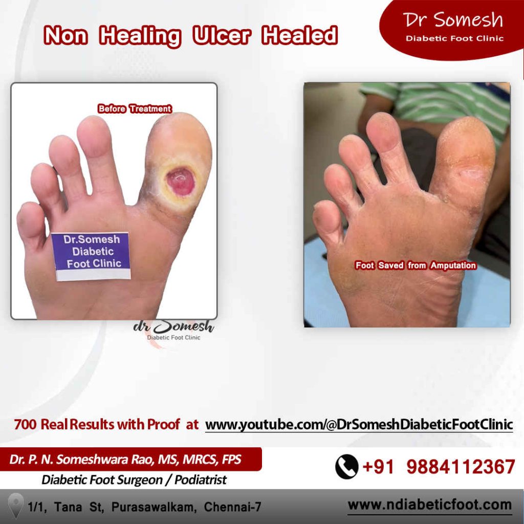 podiatrist chennai | diabetic foot clinic