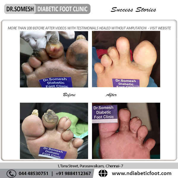 podiatrist chennai | diabetic foot clinic