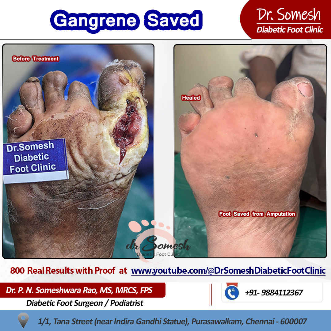 podiatrist chennai | diabetic foot clinic