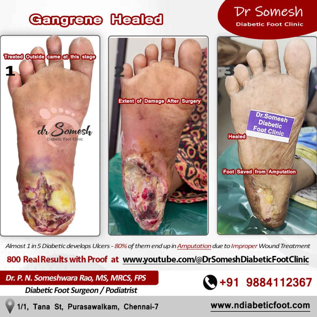 podiatrist chennai | diabetic foot clinic