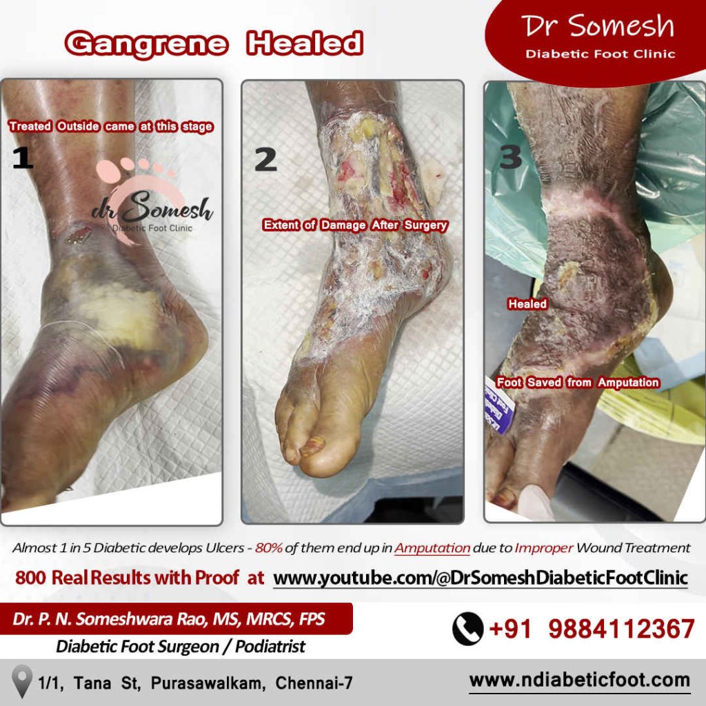 Podiatrsit Chennai | Diabetic Foot Clinic