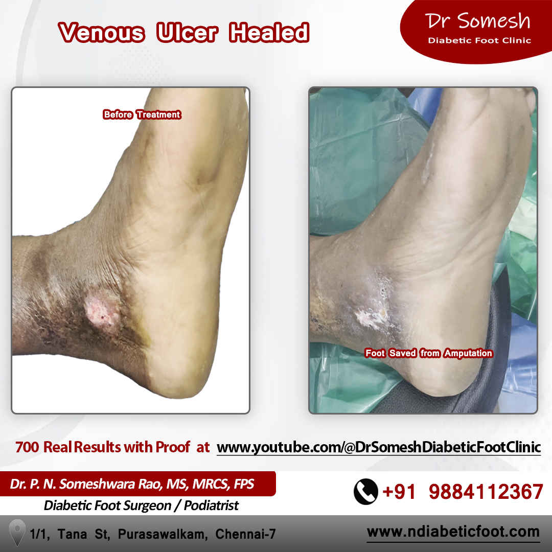 podiatrist chennai | diabetic foot clinic