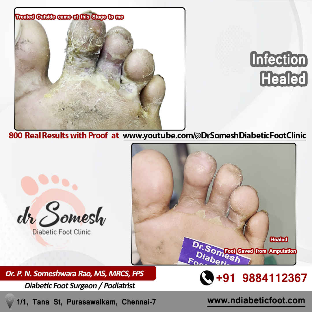 podiatrist chennai | diabetic foot clinic