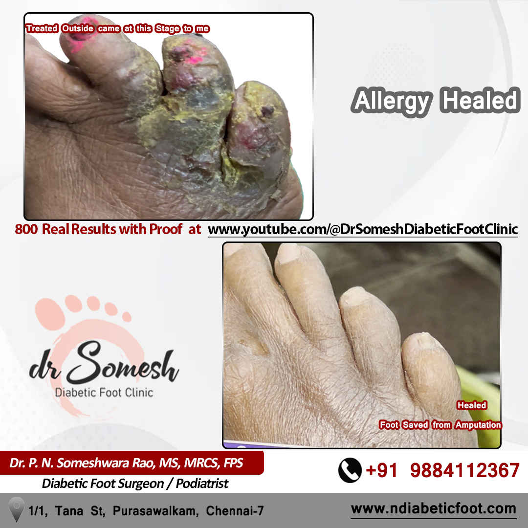podiatrist chennai | diabetic foot clinic