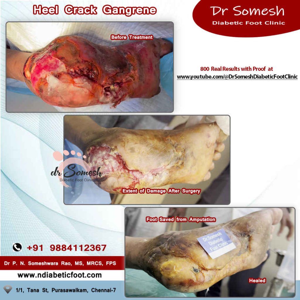 podiatrist chennai | diabetic foot clinic