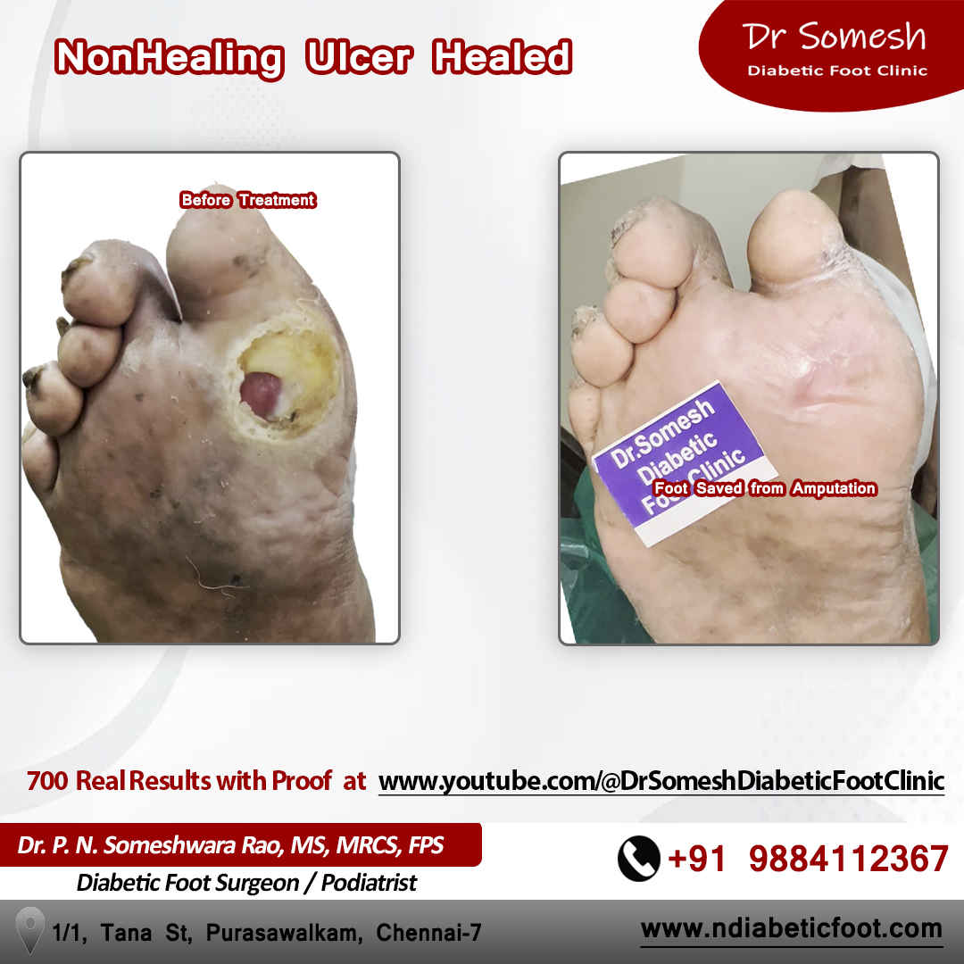 Podiatrsit Chennai | Diabetic Foot Clinic