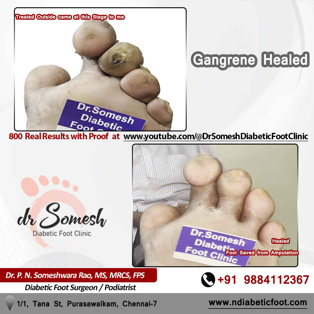 podiatrist chennai | diabetic foot clinic