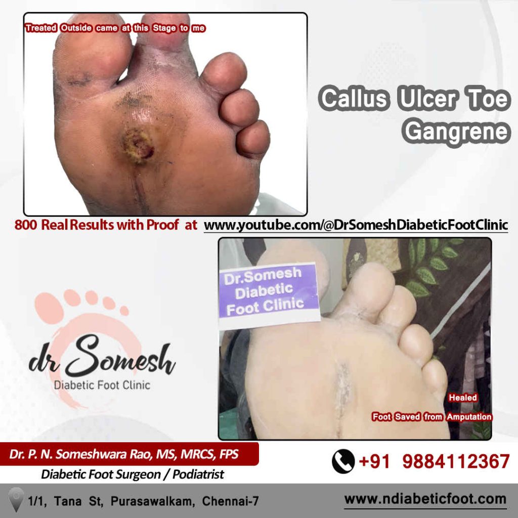 podiatrist chennai | diabetic foot clinic