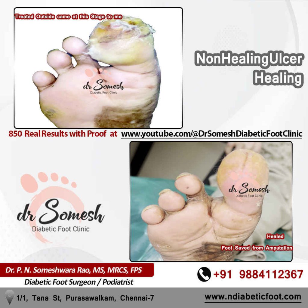 podiatrist chennai | diabetic foot ulcer
