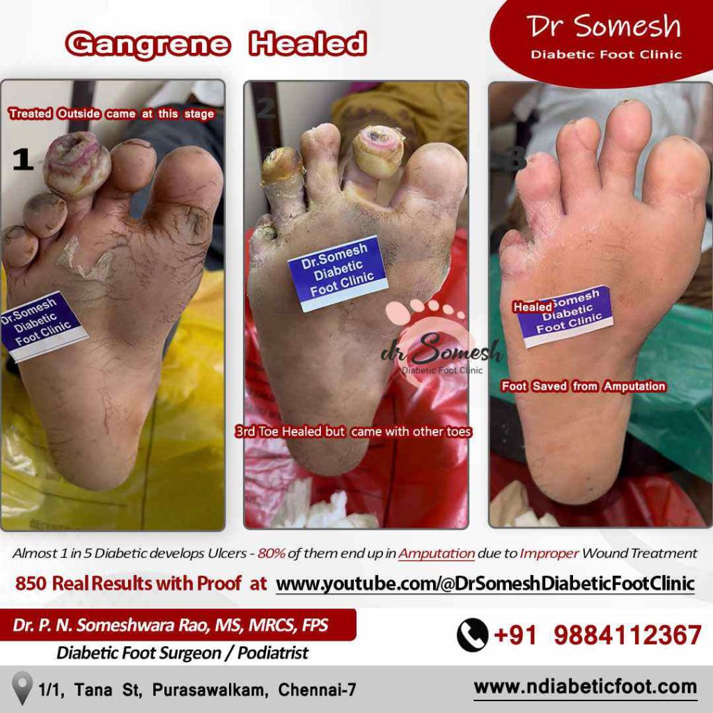 podiatrist chennai | diabetic foot | corn ulcer