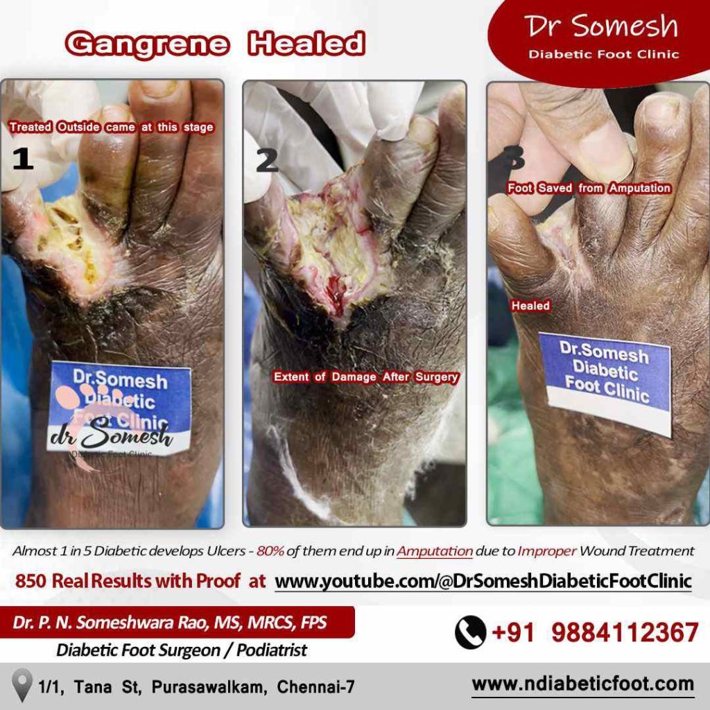 podiatrist chennai | diabetic foot ulcer