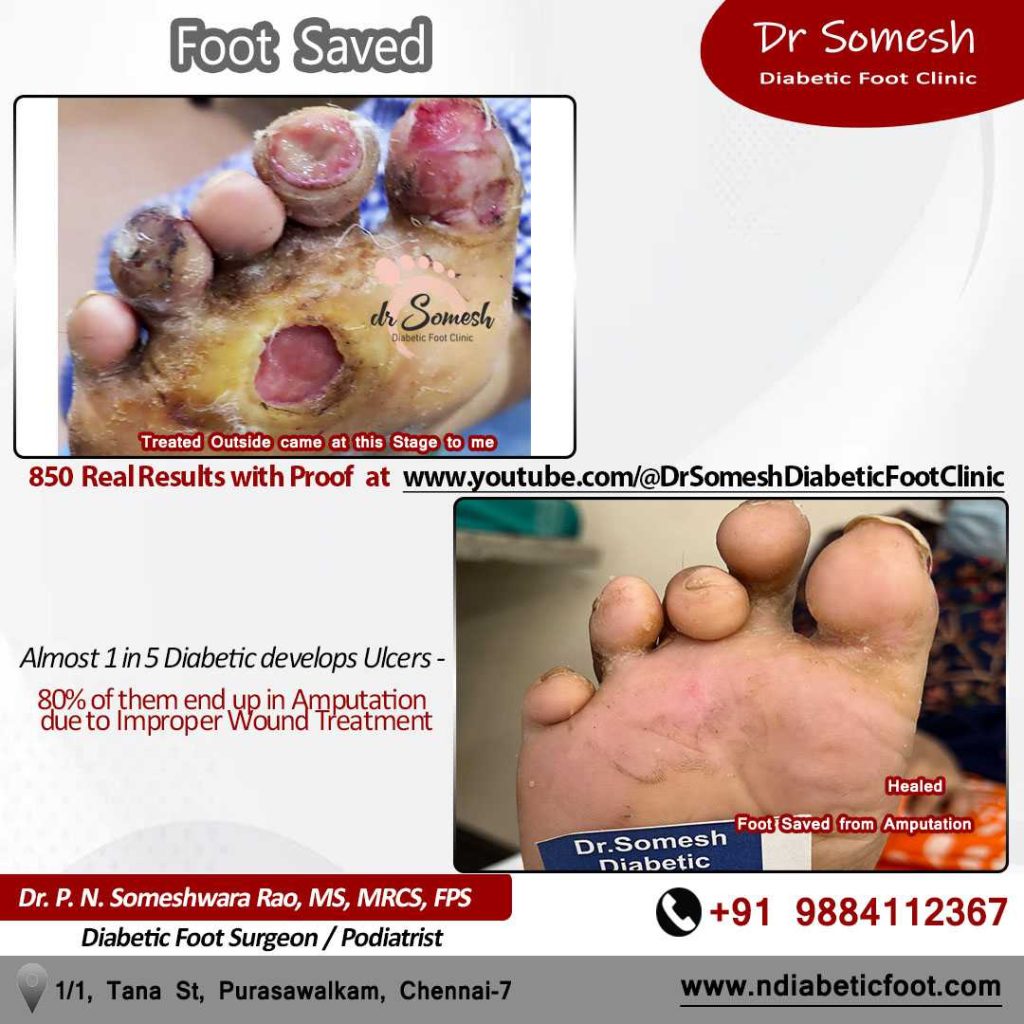 podiatrist chennai | diabetic foot ulcers