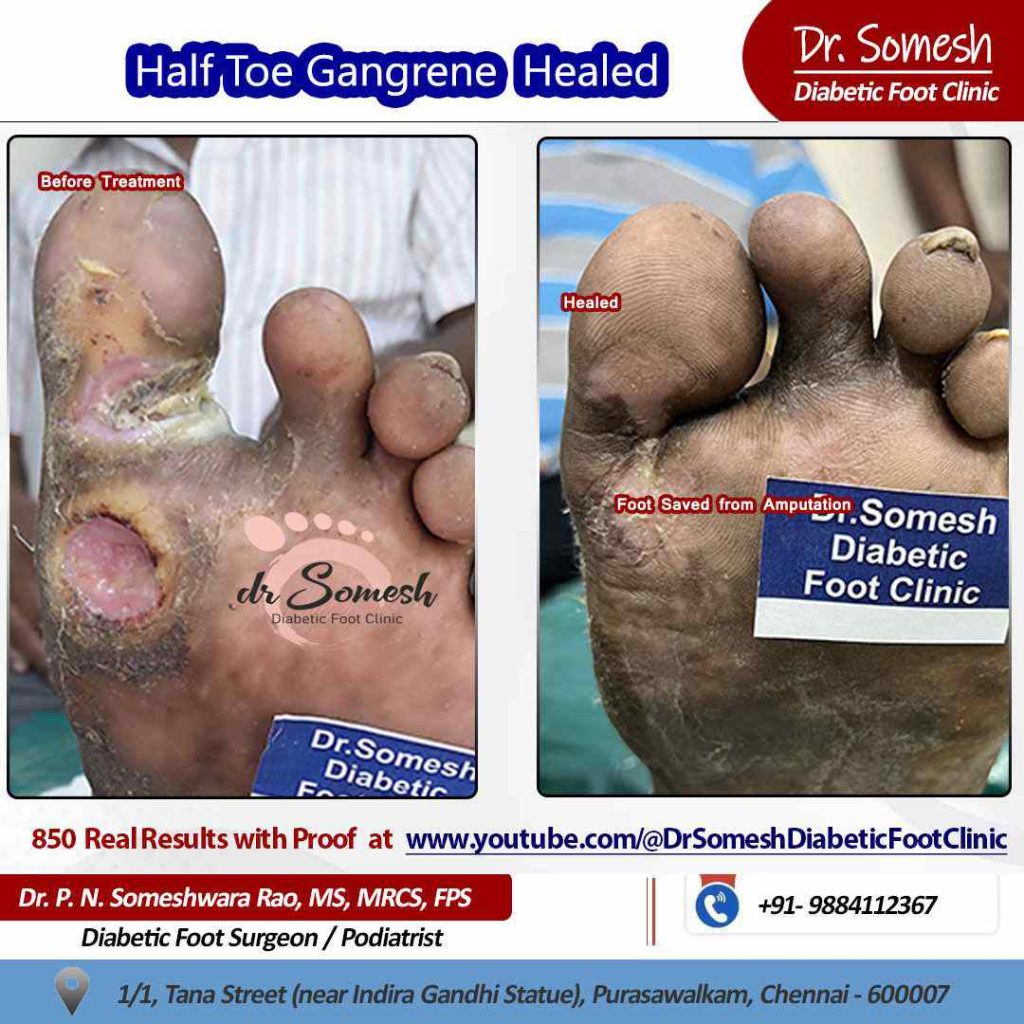 podiatrist chennai | diabetic foot