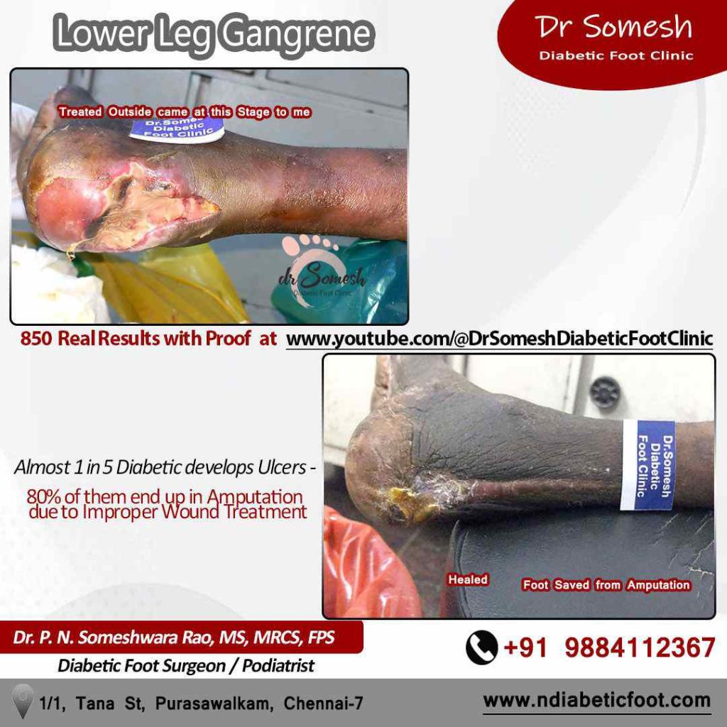 podiatrist chennai | diabetic foot ulcer