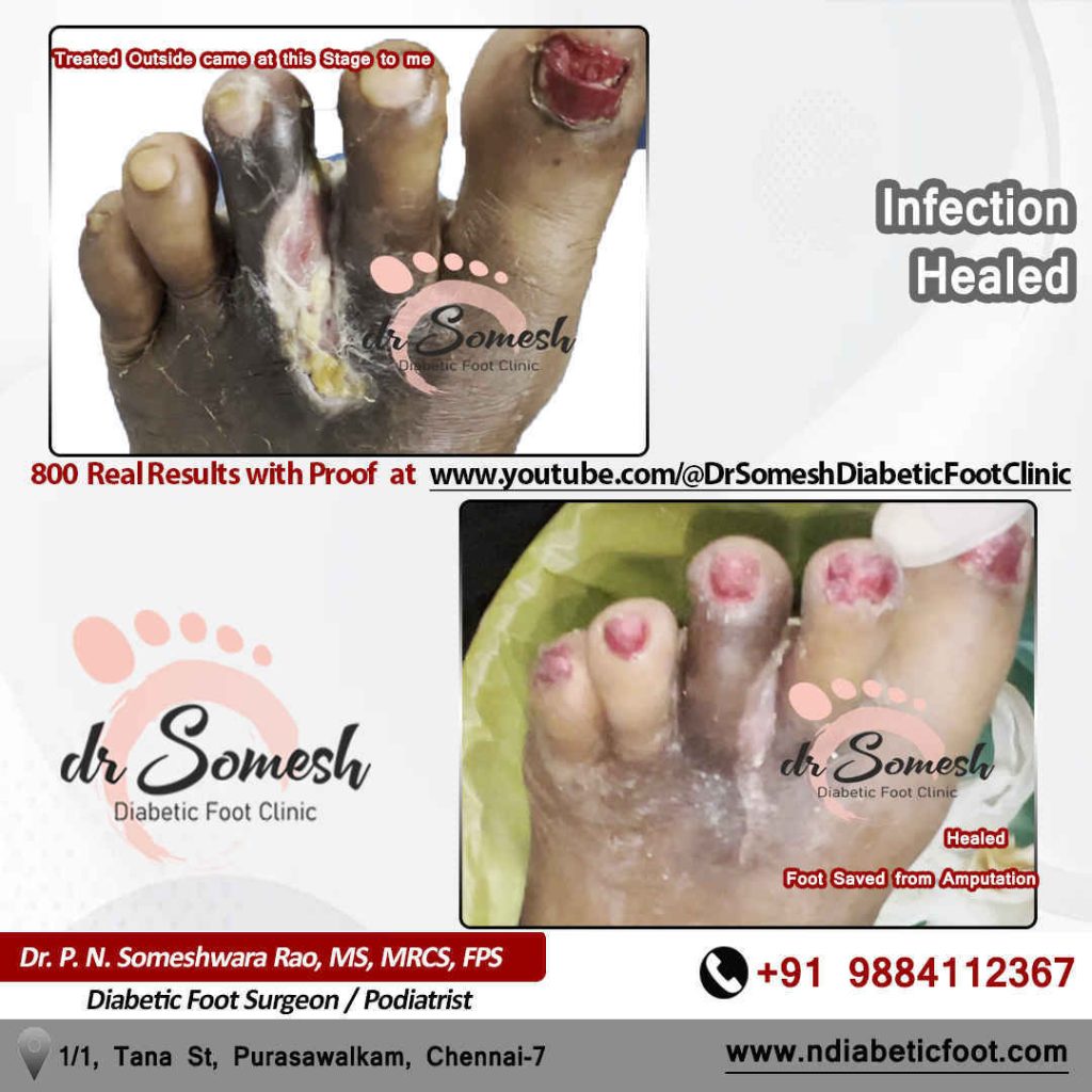 podiatrist chennai | diabetic foot ulcer