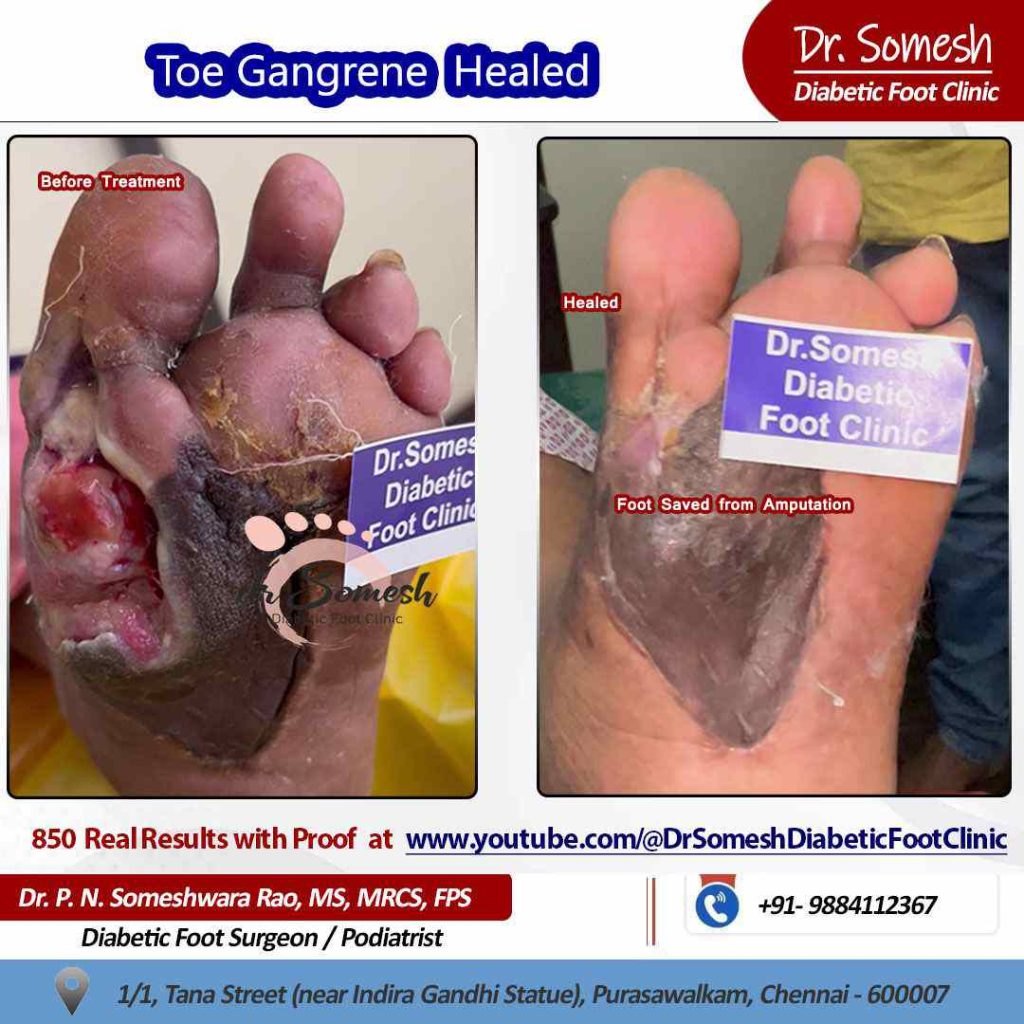 podiatrist chennai | diabetic foot ulcer