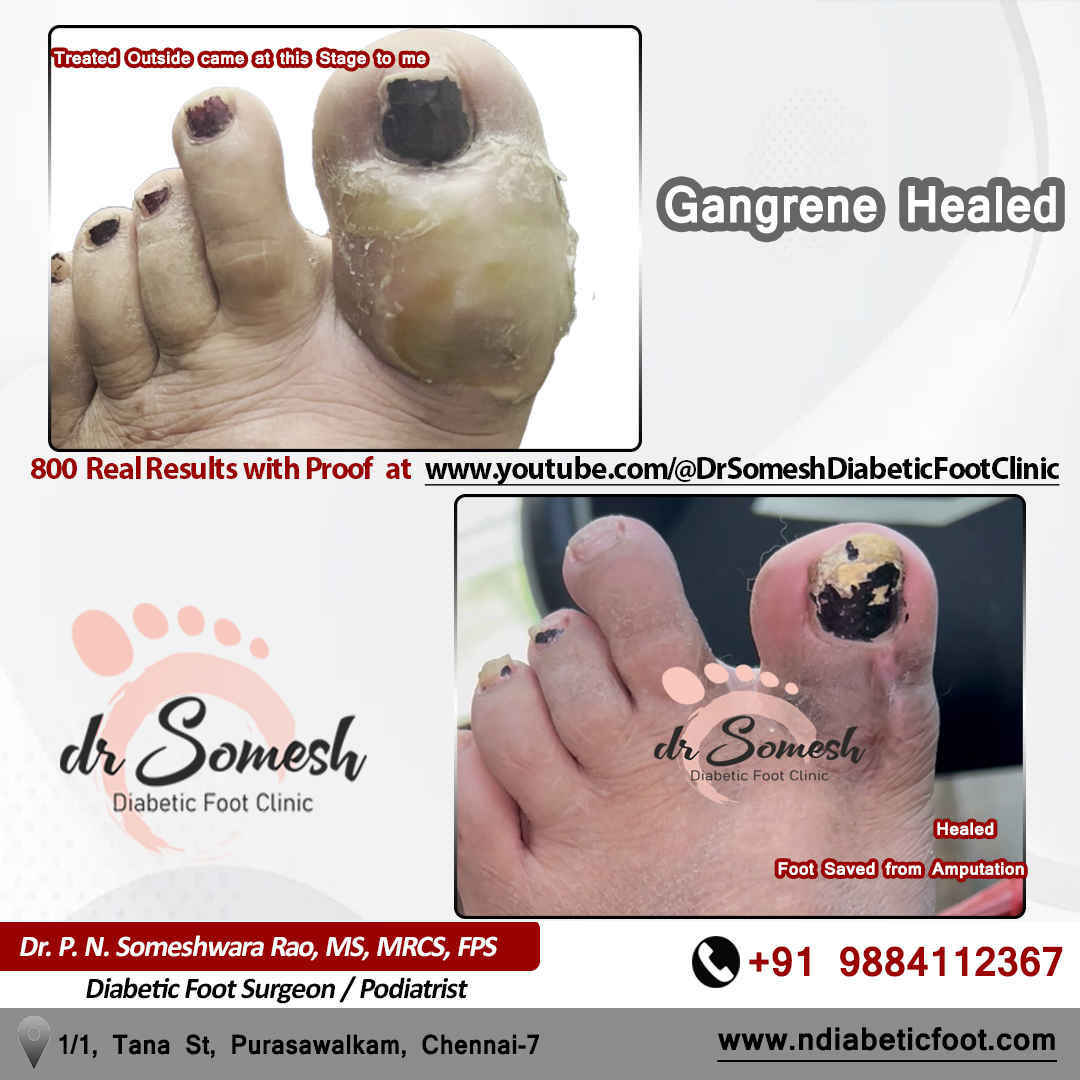podiatrist chennai | diabetic foot ulcer