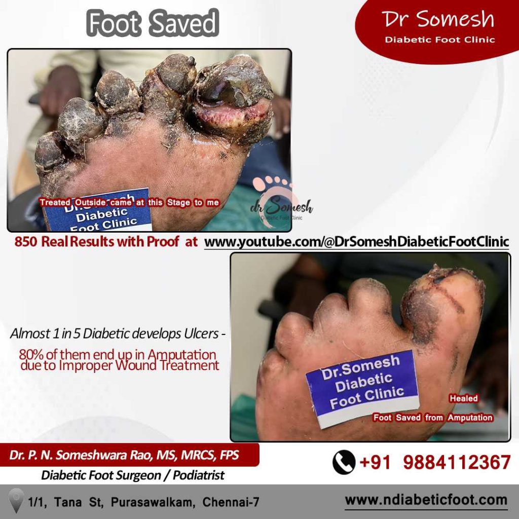 podiatrist chennai | diabetic foot ulcers