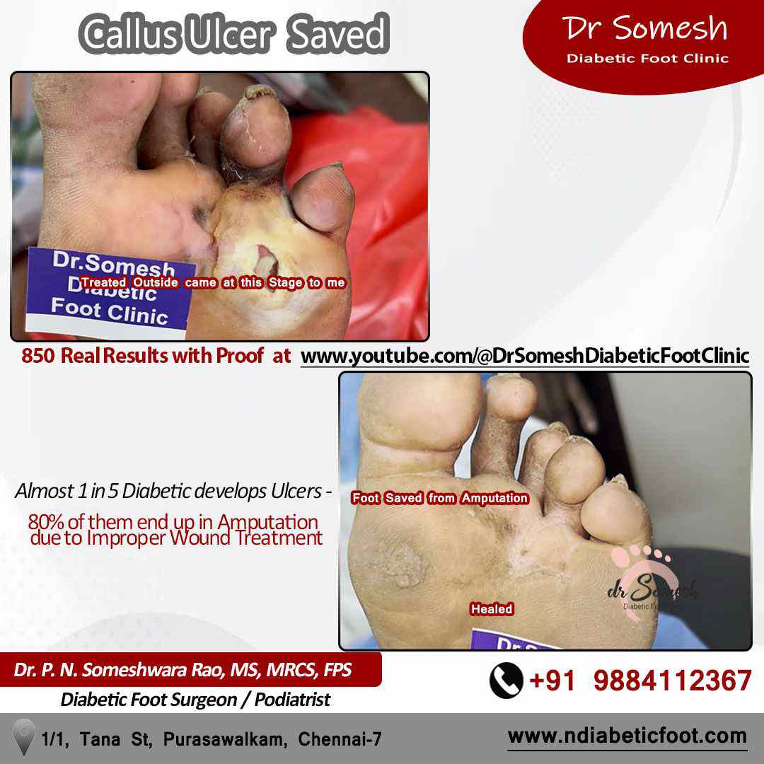 podiatrist chennai | diabetic foot ulcer