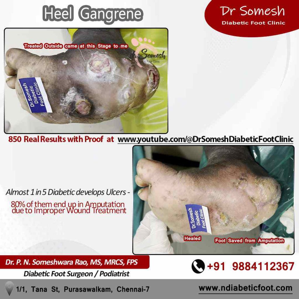 podiatrist chennai | diabetic foot ulcer