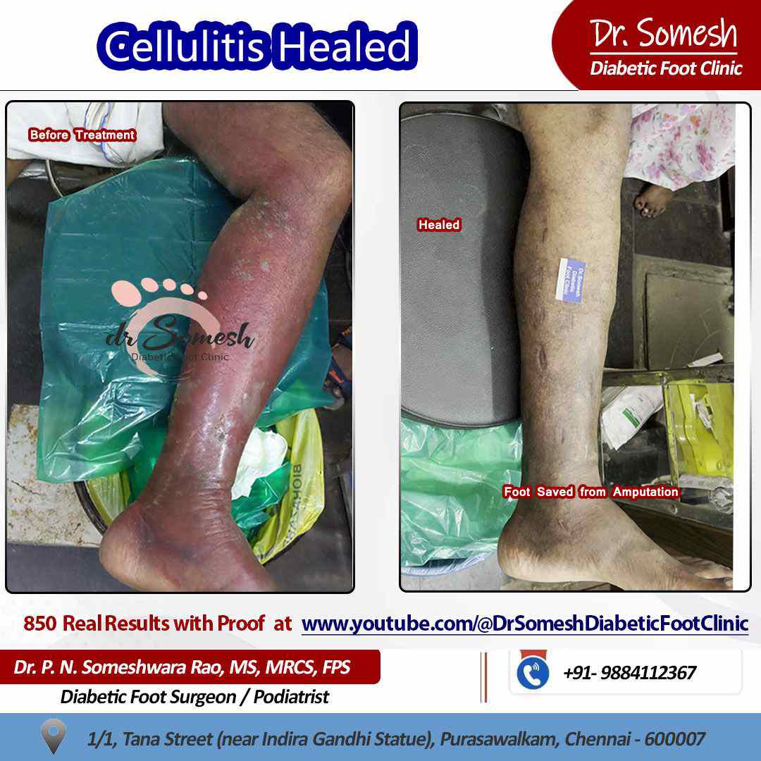 podiatrist chennai | cellulitis infection