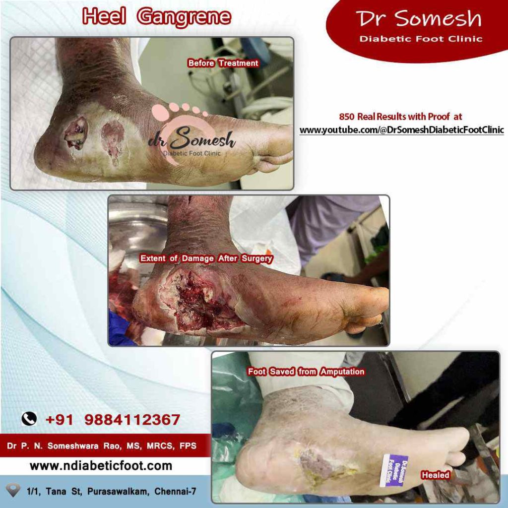 podiatrist chennai | gangrene foot