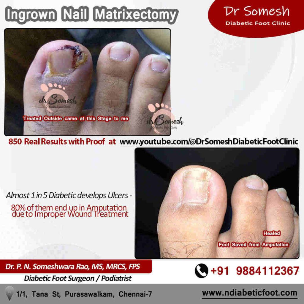 podiatrist chennai | ingrown toe nail