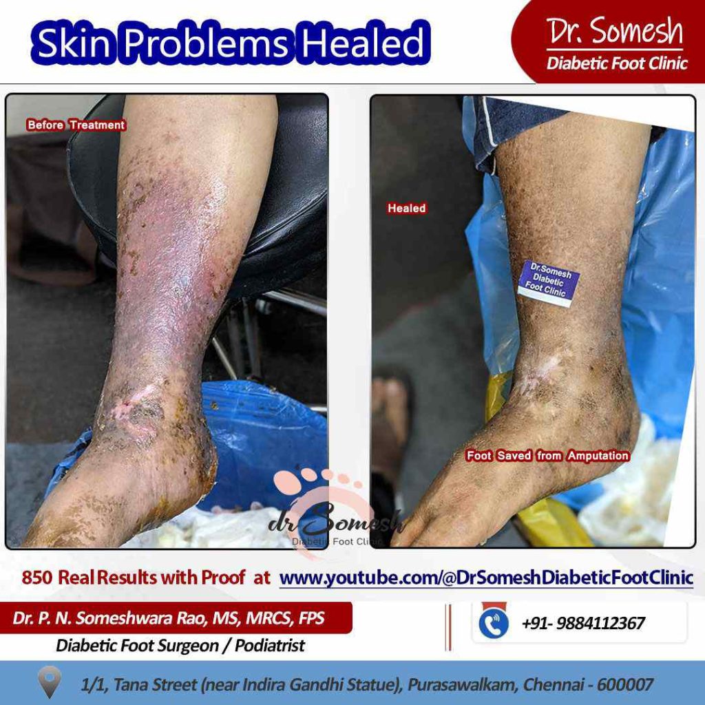 podiatrist chennai | cellulitis leg