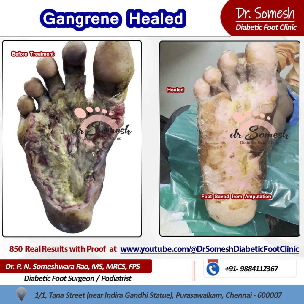 podiatrist chennai | Gangrene Foot